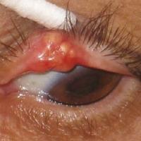 
	Sebaceous gland carcinoma&nbsp;