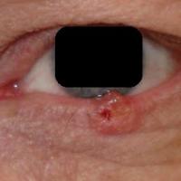 
	Sebaceous gland carcinoma
