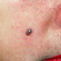 
	Spiradenoma

	An atypical site. The lesion had…