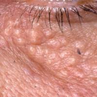 
	Syringoma