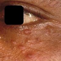 
	Trichoepithelioma - multiple