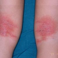 
	Atopic eczema - flexural
Copied with kind…