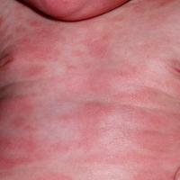 
	Atopic eczema

	Ill-defined erythema