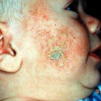 
	Atopic eczema - infected&nbsp;

	Copied with…
