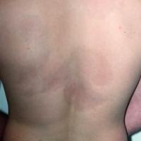 
	Atrophoderma of Pasini and Pierini