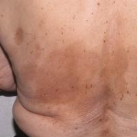 Atrophoderma of Pasini and Pierini