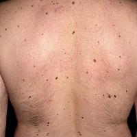 
	A larger number of lesions - referral…