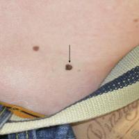 
	Dysplastic naevus - solitary
	
	This patient…