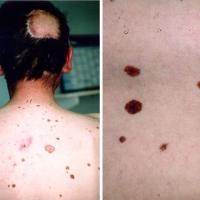 FAMMM - Familial Atypical Moles and Melanoma…