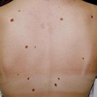 
	Atypical melanocytic naevi
	
	Copied with kind…