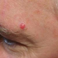 
	Atypical fibroxanthoma - a very early…