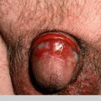 
	Erythroplasia of Queyrat - carcinoma in situ