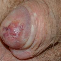 
	Lichen sclerosus

	Copied with kind permission…