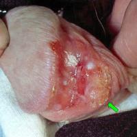 
	Squamous cell carcinoma