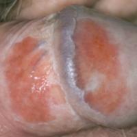 
	Balanitis