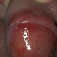 
	Lichen sclerosus&nbsp;

	Characteristic…