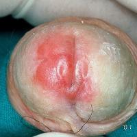 
	Lichen sclerosus&nbsp;

	Copied with kind…