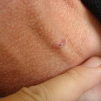 
	BCC and jugular vein&nbsp;
	
	This lesion lay…