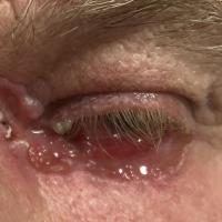 Diagnosed late, BCC can cause serious…