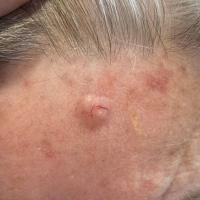BCCSome BCCs don't need a dermatoscope for a…