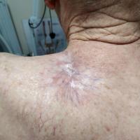 Same patient as previous figure - post…
