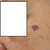 
	BCC in a patient with brown skin…