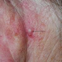
	BCC behind ear
	
	This subtle lesion was found…