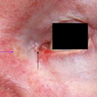 
	BCC medial canthus - a case of a watering…