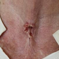 
	BCC - post tracheostomy
	
	This patient had a…