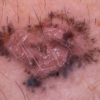 Dermoscopic appearance of previous…