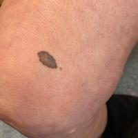 An incidental finding of melanoma in a patient…