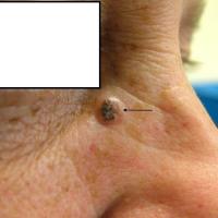 Solid BCC with pigmentIt is quite common for BCC…