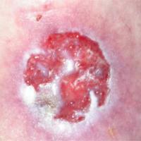BCC masquereding as a leg ulcerNot all leg ulcers…