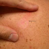 
	Superficial BCC - same patient as previous…
