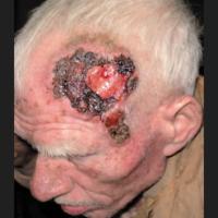 
	Advanced basosquamous carcinoma 