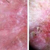 Infiltrative BCCDermoscopy revealed fine…