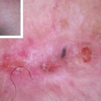 Infiltrative BCC - a stellate pattern