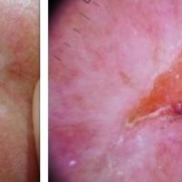 Infiltrative BCCDermoscopy shows a central…