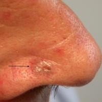 Solid BCC right side of nose&nbsp;Copied with…