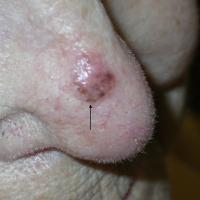
	BCC right side of nose