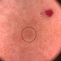 Dermoscopy can be so helpful in early…