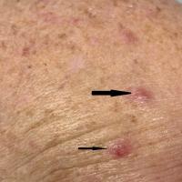 Multiple BCCThe upper lesion (thick black arrow)…