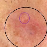 Dermoscopic appearance of previous figure (upper…