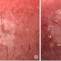 Same patient - SGH (left image) and BCC (right…