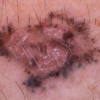 Dermoscopic appearance of previous figureMany…