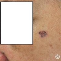 BCC in skin of colour - a pigmented rolled…