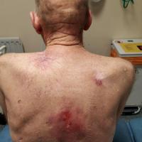 Same patient - post radiotherapyIn such cases,…