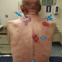 BCC - neglectedIncisional biopsies were needed as…