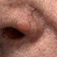 Another BCC with arborising vessels visible to…