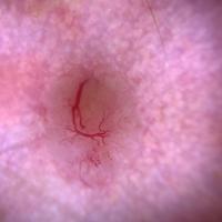 Dermoscopic appearance of previous…